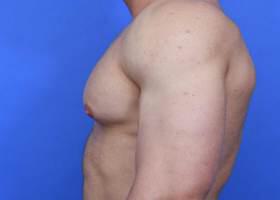 Gynecomastia Surgery Before & After Image