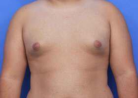 Gynecomastia Surgery Before & After Image