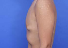 Gynecomastia Surgery Before & After Image