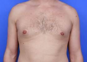 Gynecomastia Surgery Before & After Image