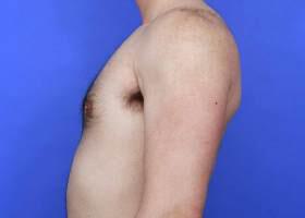 Gynecomastia Surgery Before & After Image