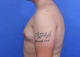 Gynecomastia Surgery Before & After Image
