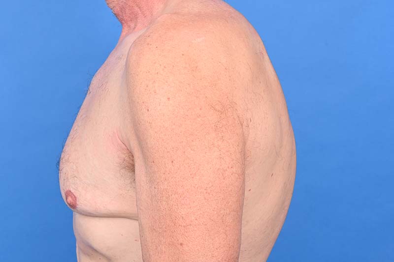 Gynecomastia Surgery Before & After Image