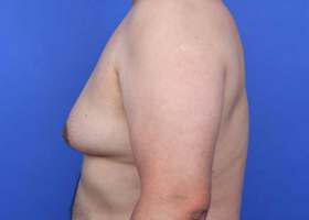 Gynecomastia Surgery Before & After Image
