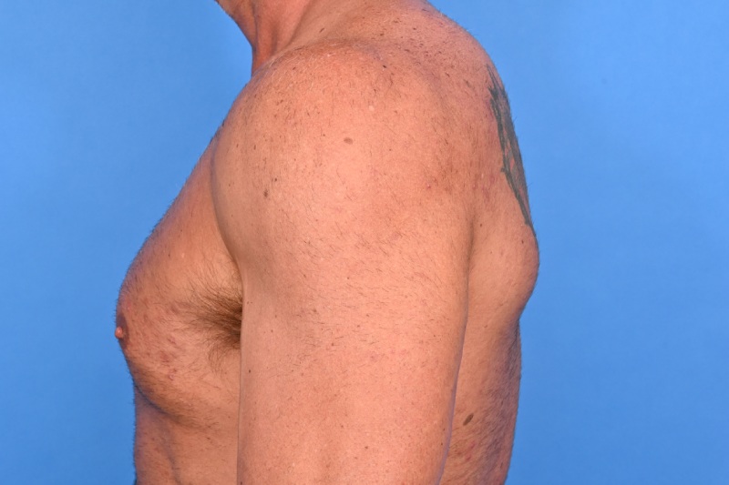 Gynecomastia Surgery Before & After Image