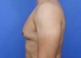 Gynecomastia Surgery Before & After Image