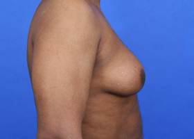 Gynecomastia Surgery Before & After Image