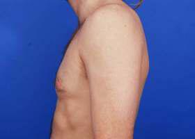 Gynecomastia Surgery Before & After Image