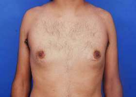 Gynecomastia Surgery Before & After Image