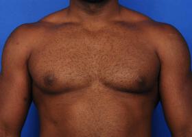 Gynecomastia Surgery Before & After Image