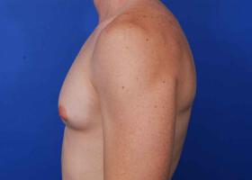 Gynecomastia Surgery Before & After Image