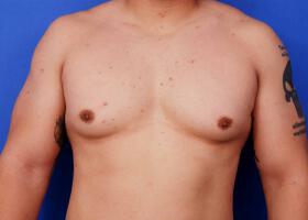 Gynecomastia Surgery Before & After Image