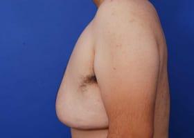 Gynecomastia Surgery Before & After Image