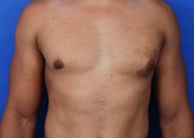 Gynecomastia Surgery Before & After Image