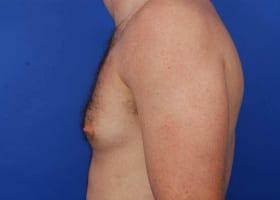 Gynecomastia Surgery Before & After Image