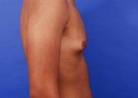 Gynecomastia Surgery Before & After Image