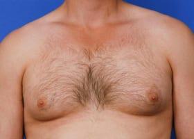 Gynecomastia Surgery Before & After Image