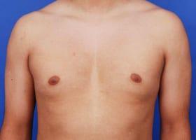 Gynecomastia Surgery Before & After Image