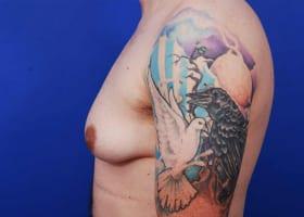 Gynecomastia Surgery Before & After Image