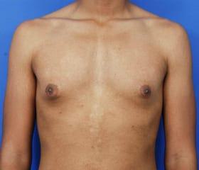 Gynecomastia Surgery Before & After Image