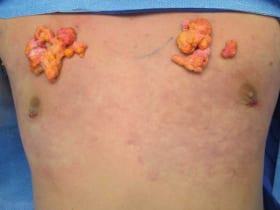 Gynecomastia Surgery Before & After Image