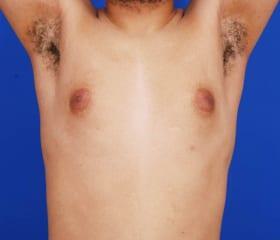 Gynecomastia Surgery Before & After Image