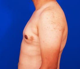 Gynecomastia Surgery Before & After Image