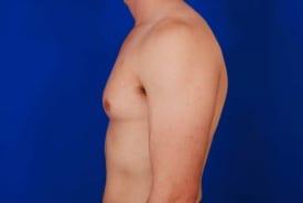 Gynecomastia Surgery Before & After Image