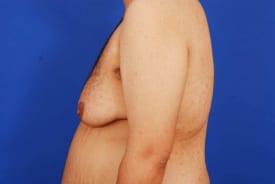 Gynecomastia Surgery Before & After Image