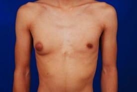 Gynecomastia Surgery Before & After Image