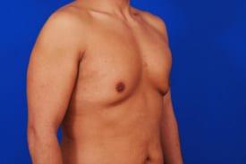 Gynecomastia Surgery Before & After Image