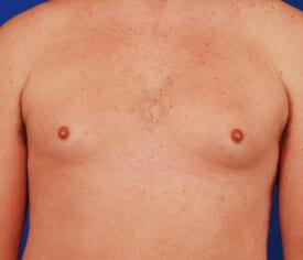 Gynecomastia Surgery Before & After Image