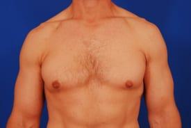 Gynecomastia Surgery Before & After Image