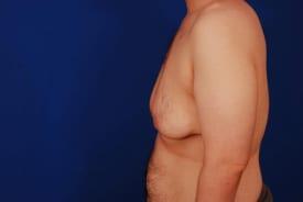 Gynecomastia Surgery Before & After Image