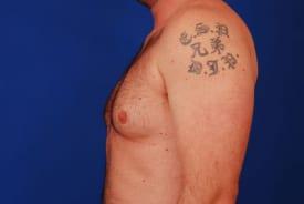 Gynecomastia Surgery Before & After Image