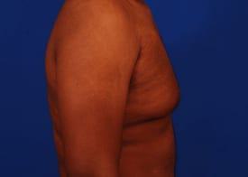Gynecomastia Surgery Before & After Image