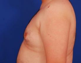 Gynecomastia Surgery Before & After Image