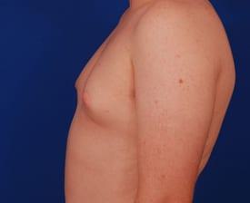 Gynecomastia Surgery Before & After Image