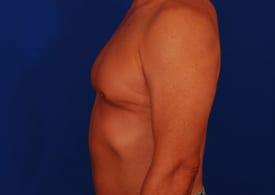 Gynecomastia Surgery Before & After Image
