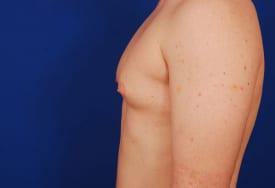 Gynecomastia Surgery Before & After Image