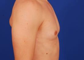 Gynecomastia Surgery Before & After Image