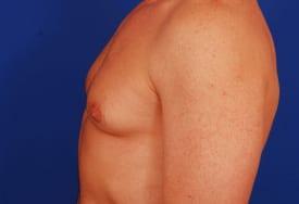 Gynecomastia Surgery Before & After Image