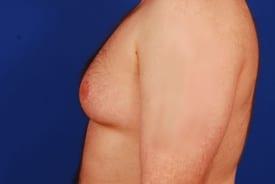 Gynecomastia Surgery Before & After Image