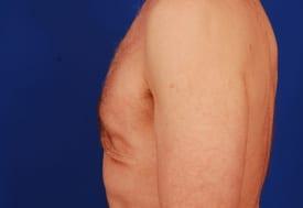 Gynecomastia Surgery Before & After Image