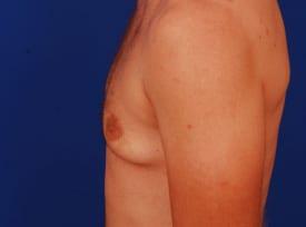 Gynecomastia Surgery Before & After Image