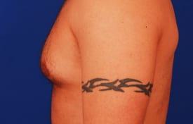 Gynecomastia Surgery Before & After Image
