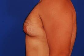 Gynecomastia Surgery Before & After Image