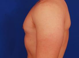 Gynecomastia Surgery Before & After Image