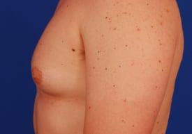 Gynecomastia Surgery Before & After Image