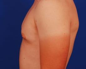 Gynecomastia Surgery Before & After Image